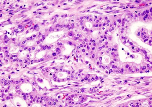 pancreatic adenocarcinoma