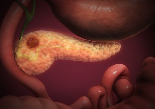 pancreatic cancer