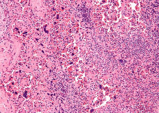 systemic lupus erythematosus